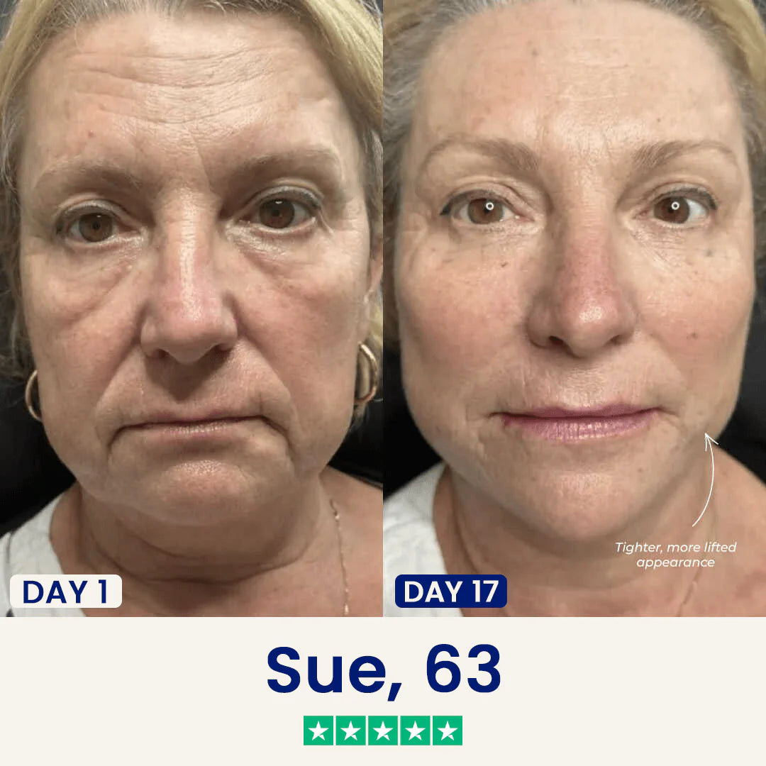 Slimora™ Chin Fat Reducer Mask
