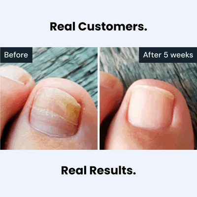 Comfort Cloud™ Nail Antifungal Pen
