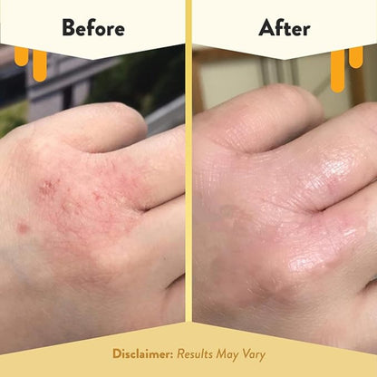 Eczema Honey Relief Cream