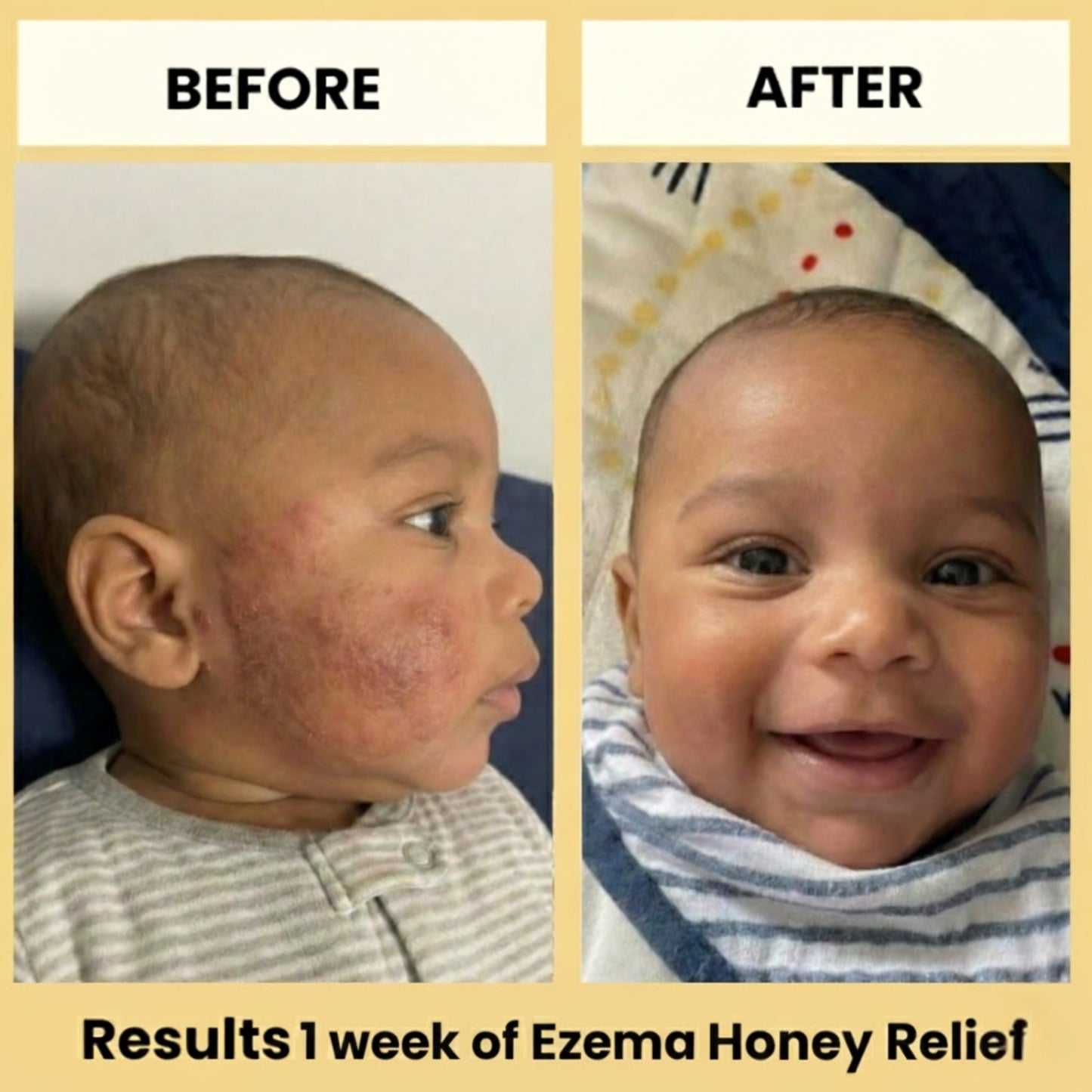 Eczema Honey Relief Cream